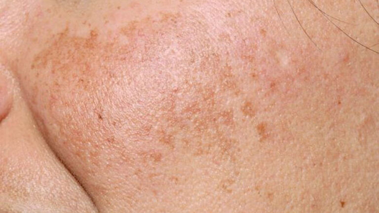 Ciencia galénica contra el melasma: La fórmula magistral sigue siendo el estándar