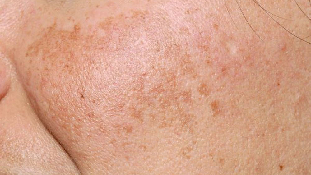 Toma cerrada de una persona con melasma