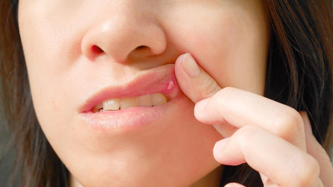 Fotografía de toma cerrada de una boca con el labio levantada mostrando el afta del labio superio.